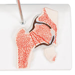 Human Femoral Fracture & Hip Osteoarthritis Model - 3B Smart Anatomy