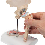 Human Femoral Fracture & Hip Osteoarthritis Model - 3B Smart Anatomy