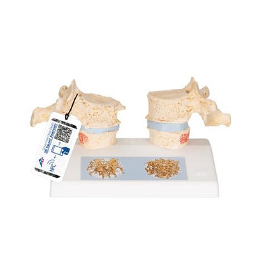 Osteoporosis Didactic Model - 3B Smart Anatomy