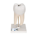 Lower Twin-Root Molar with Cavities Human Tooth Model, 2 part - 3B Smart Anatomy