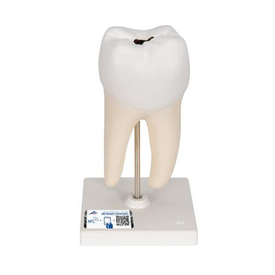 Lower Twin-Root Molar with Cavities Human Tooth Model, 2 part - 3B Smart Anatomy