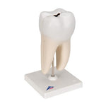 Lower Twin-Root Molar with Cavities Human Tooth Model, 2 part - 3B Smart Anatomy