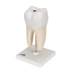 Lower Twin-Root Molar with Cavities Human Tooth Model, 2 part - 3B Smart Anatomy