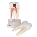 Lower Twin-Root Molar with Cavities Human Tooth Model, 2 part - 3B Smart Anatomy