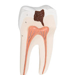 Lower Twin-Root Molar with Cavities Human Tooth Model, 2 part - 3B Smart Anatomy