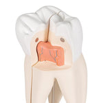 Upper Triple-Root Molar Human Tooth Model, 3 part - 3B Smart Anatomy