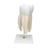 Giant Molar with Dental Cavities Human Tooth Model, 15 times Life-Size, 6 part - 3B Smart Anatomy