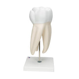Giant Molar with Dental Cavities Human Tooth Model, 15 times Life-Size, 6 part - 3B Smart Anatomy
