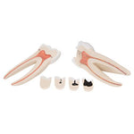 Giant Molar with Dental Cavities Human Tooth Model, 15 times Life-Size, 6 part - 3B Smart Anatomy