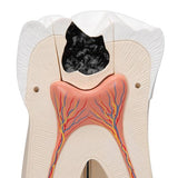 Giant Molar with Dental Cavities Human Tooth Model, 15 times Life-Size, 6 part - 3B Smart Anatomy