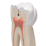 Giant Molar with Dental Cavities Human Tooth Model, 15 times Life-Size, 6 part - 3B Smart Anatomy