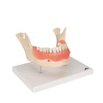 Dental Disease Model, Magnified 2 times, 21 parts - 3B Smart Anatomy