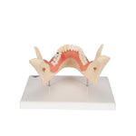 Dental Disease Model, Magnified 2 times, 21 parts - 3B Smart Anatomy