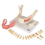 Dental Disease Model, Magnified 2 times, 21 parts - 3B Smart Anatomy