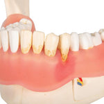 Dental Disease Model, Magnified 2 times, 21 parts - 3B Smart Anatomy