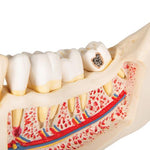 Dental Disease Model, Magnified 2 times, 21 parts - 3B Smart Anatomy
