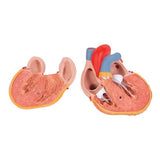 Classic Human Heart Model with Left Ventricular Hypertrophy (LVH), 2 part - 3B Smart Anatomy