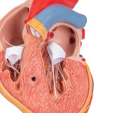 Classic Human Heart Model with Left Ventricular Hypertrophy (LVH), 2 part - 3B Smart Anatomy