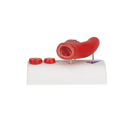 Arteriosclerosis Model, with Cross Section of Artery, 2 part - 3B Smart Anatomy