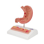 Human Stomach Section Model with Ulcers - 3B Smart Anatomy