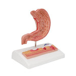 Human Stomach Section Model with Ulcers - 3B Smart Anatomy