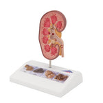 Kidney Stone Model - 3B Smart Anatomy