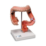 Intestinal Diseases Model - 3B Smart Anatomy