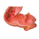 Intestinal Diseases Model - 3B Smart Anatomy
