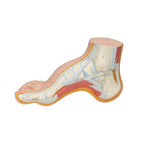 Hollow Foot (Pes Cavus) Model - 3B Smart Anatomy