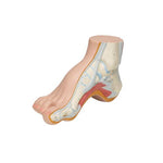 Hollow Foot (Pes Cavus) Model - 3B Smart Anatomy
