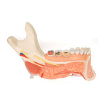 Comprehensive Lower Jaw Model (Left Half) with Diseased Teeth, Nerves, Vessels & Glands, 19 part - 3B Smart Anatomy