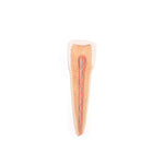 Comprehensive Lower Jaw Model (Left Half) with Diseased Teeth, Nerves, Vessels & Glands, 19 part - 3B Smart Anatomy