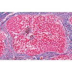 Human Pathology - Spanish